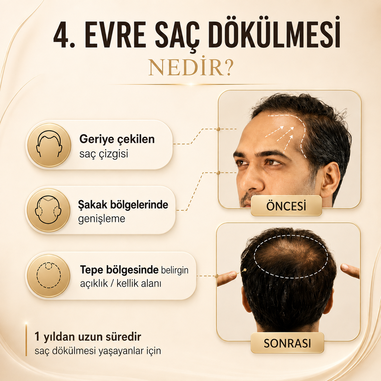 SPARTAN SAÇ ÇIKARAN ŞAMPUAN